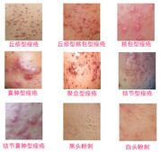 痤疮的症状