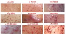 痤疮的主要症状