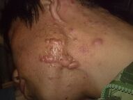 痤疮是怎么引起的